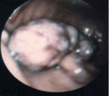 胃神经官能症(图1) 胃神经官能症(图1)