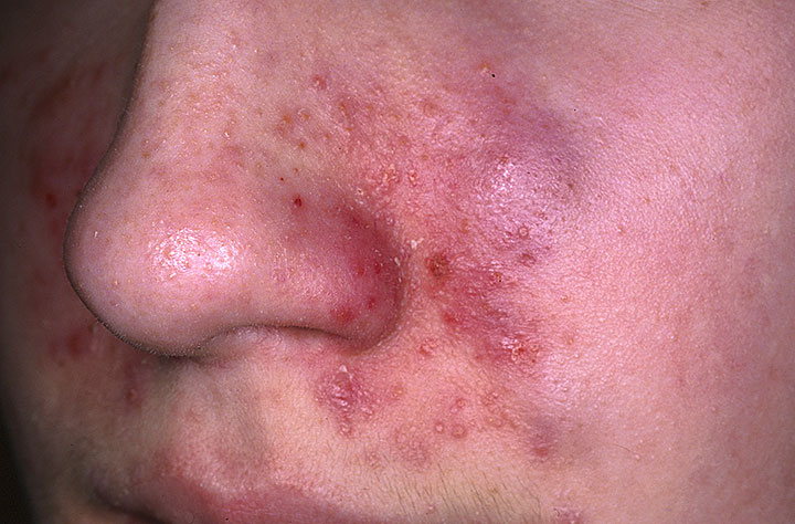 seborrheic dermatitis